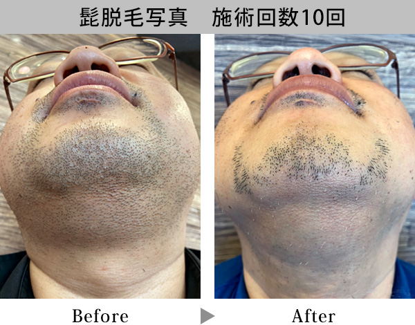 脱毛写真