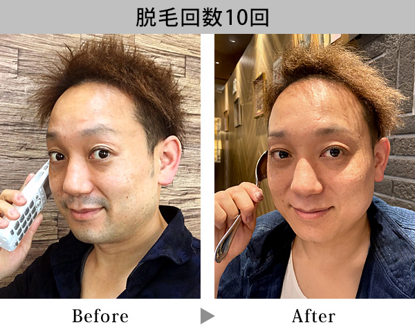 脱毛写真
